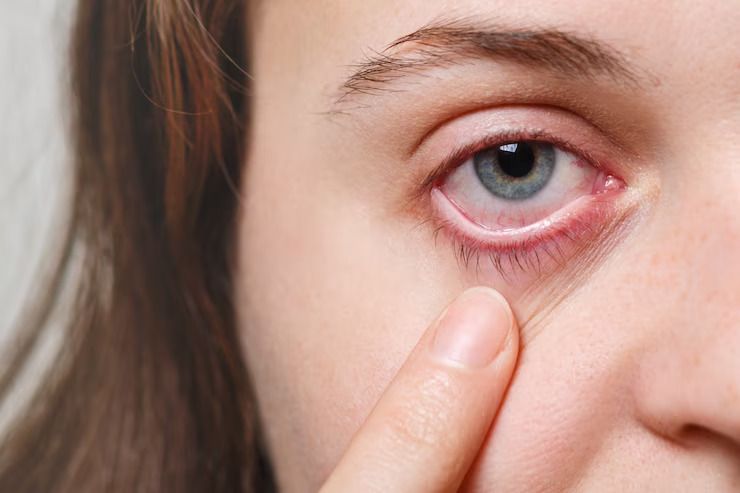 PN9. Understanding Eye Infections: Causes, Symptoms, and Effective Treatments
